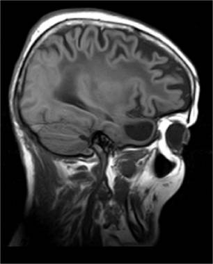 Resonancia magnética del cerebro de un paciente con leucoencefalopatía megalencefálica con quistes subcorticales (MLC).