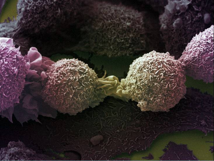 Vista de células tumorales de pulmón al microscopio electrónico. / Wellcome Images