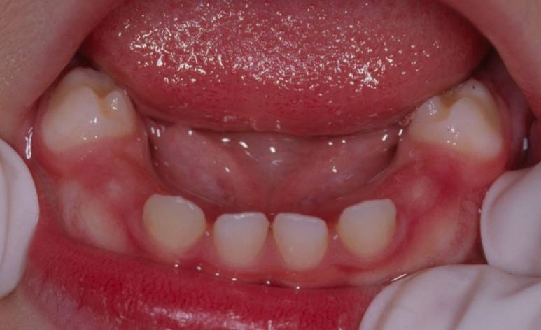 Incisivos y primeros molares primarios mandibulares de uno de los niños del estudio / Joaquín de Nova.