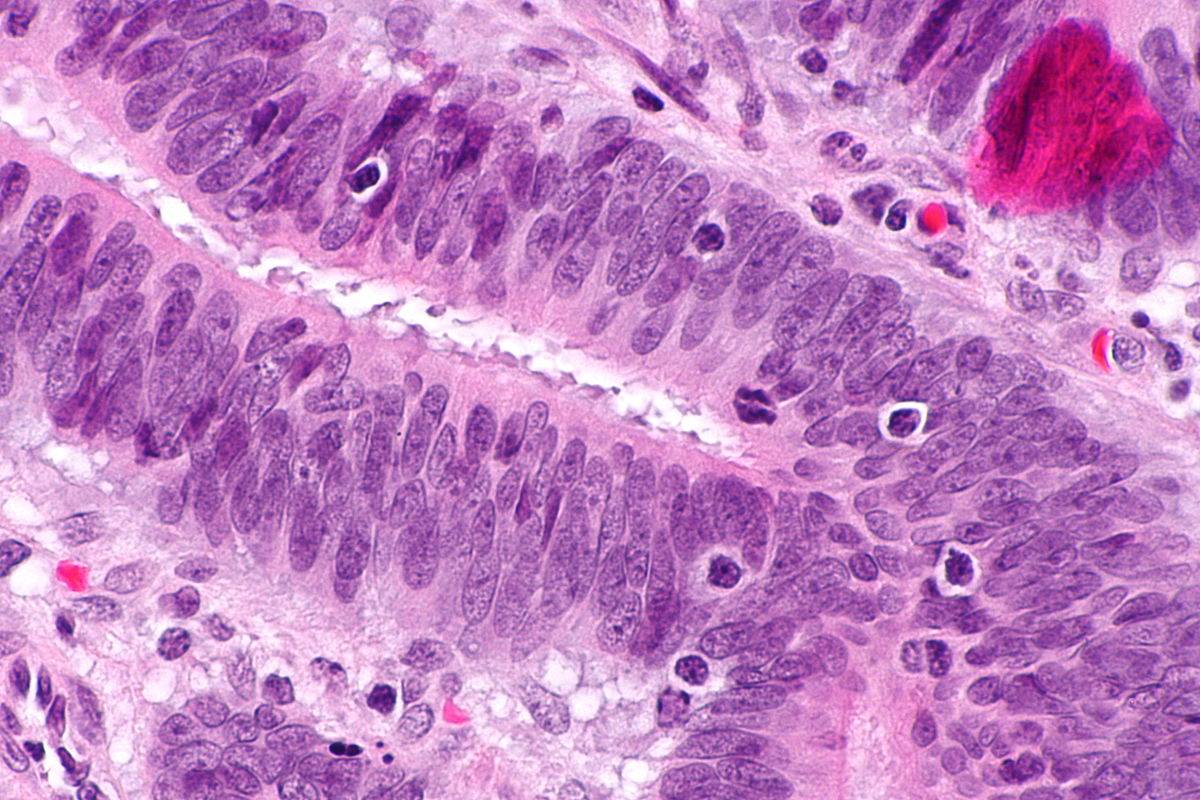 Micrografía que muestra linfocitos infiltrantes del tumor (de un cáncer colorrectal), un hallazgo asociado con tumores MSI-H, como es el caso del síndrome de Lynch. / Wikipedia
