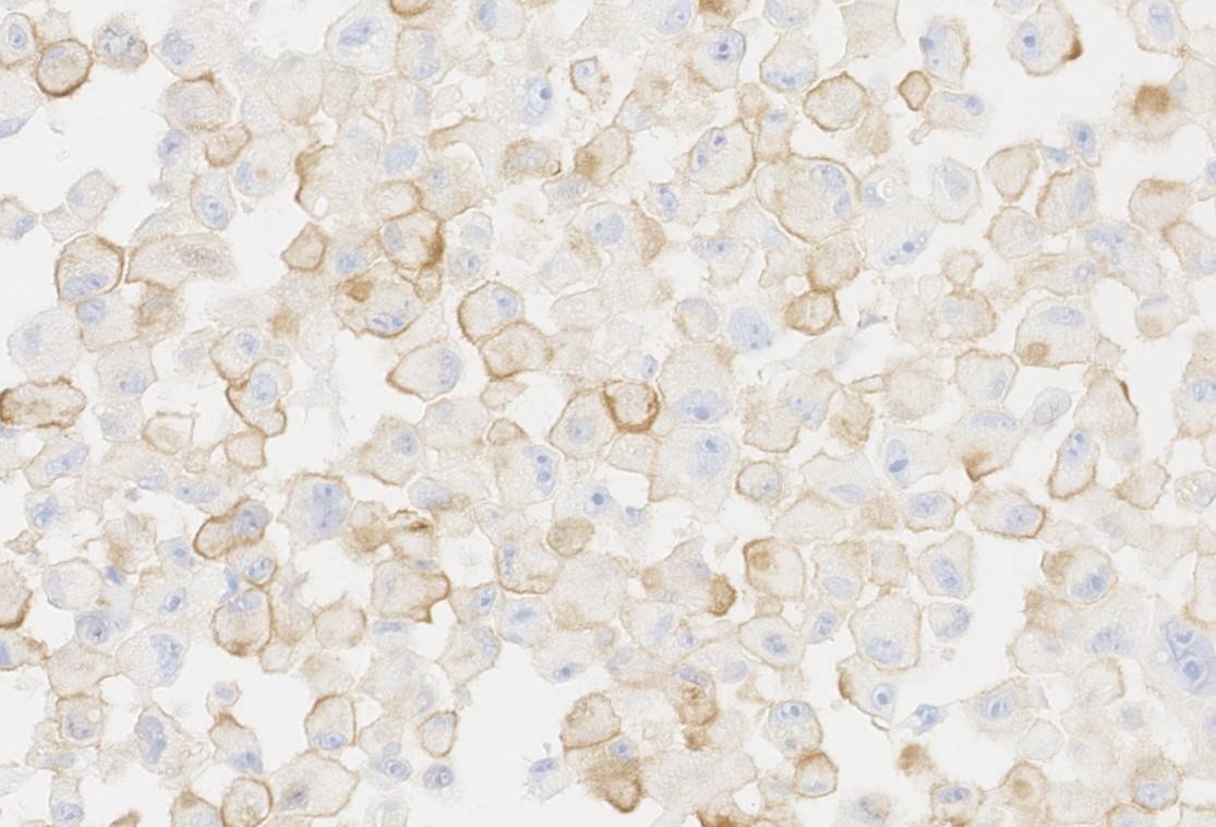 Células tumorales senescentes de melanoma humano
