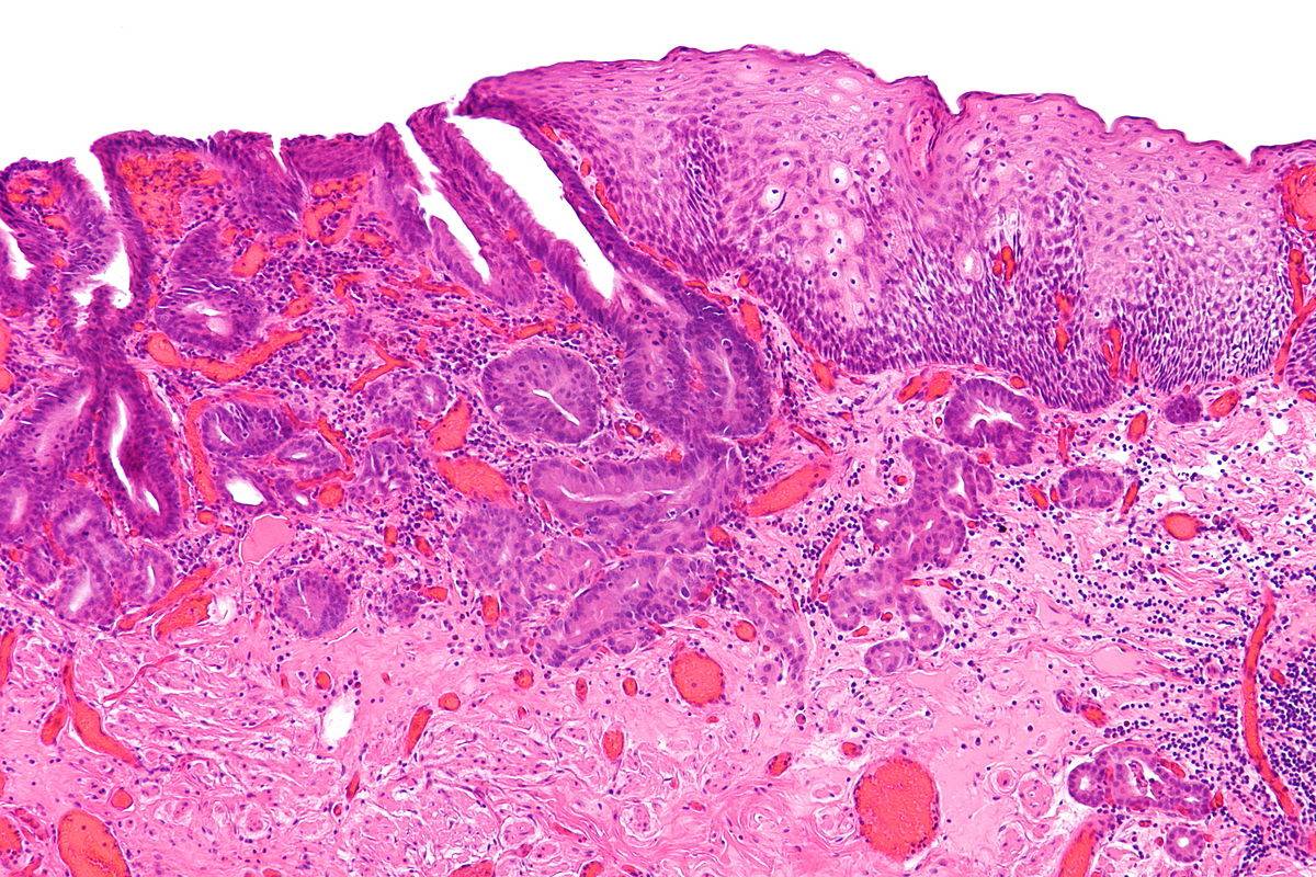Microcarcinoma de esófago. / Wikipedia