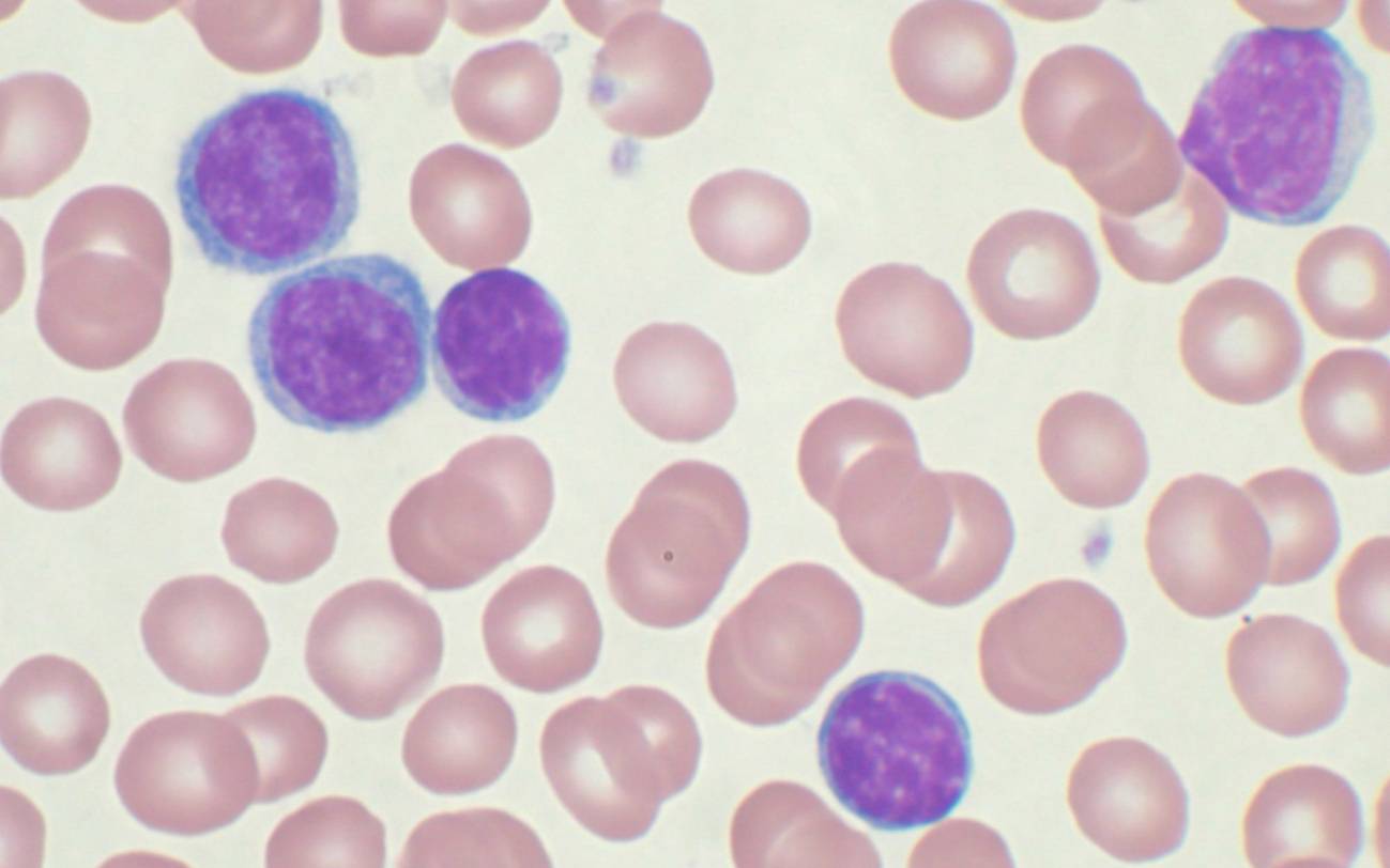 muestra sanguínea de leucemia