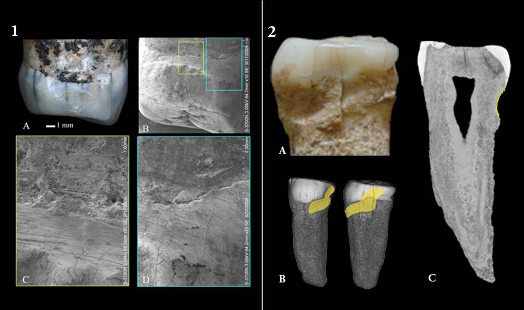 Primer premolar derecho, Yiyuan/ IVPP y Segundo premolar izquierdo, Atapuerca/CENIEH