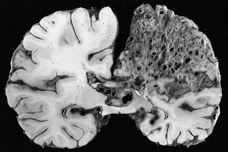 Deformación arteriovenosa en el hemisferio izquierdo típica de la enfermedad. / Wikipedia