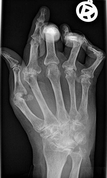 Radiografía de un paciente con artristis reumatoide. Foto: Bernd Brägelmann.