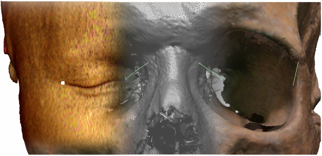 Vista de un TAC facial y de la imagen tridimensional de un cráneo.
