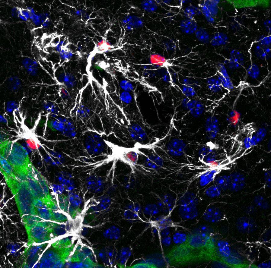 células metastáticas en el cerebro