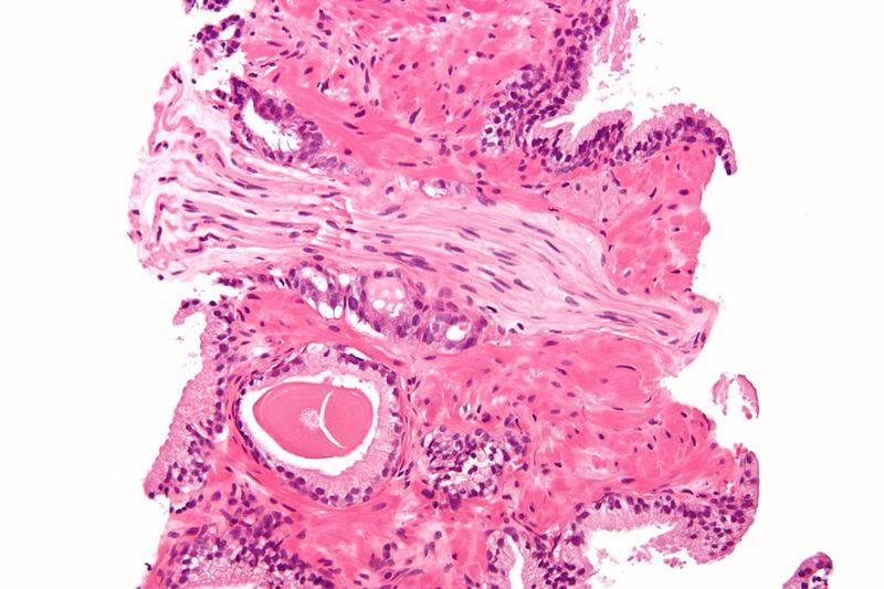 Micrografía que muestra un cáncer de próstata. / Wikipedia