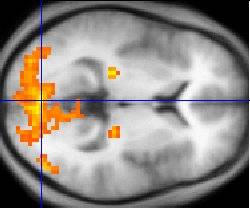 Imagen de fMRI. Foto: Wikipedia.
