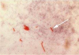 En rojo, bacilos de Mycobacterium tuberculosis. Foto: Wikipedia.