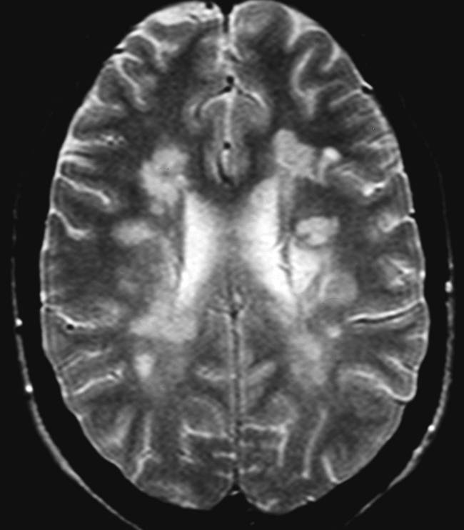 Resonancia magnética cerebral de un paciente con esclerosis múltiple.