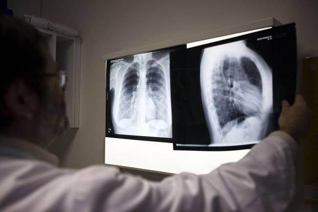 Un médico mira la radiografía de un enfermo de tuberculosis. / SINC