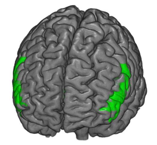 Esquema de las redes neuronales asociadas con los síntomas del Trastorno por Déficit de Atención con Hiperactividad (TDAH). Imagen: Robert Whelan/ Hugh Garavan