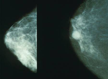 Mamografías que muestran una mama normal (izq.) y una con cáncer (der.). Imagen: Wikipedia