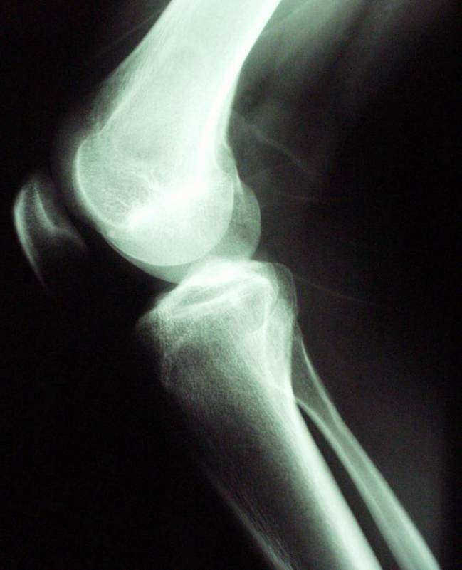 Radiografía de la articulación de una rodilla humana. Imagen: Wikipedia