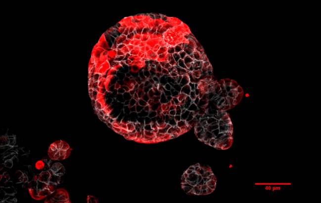 Organoide de cáncer colorrectal con células residuales responsables de la recaída