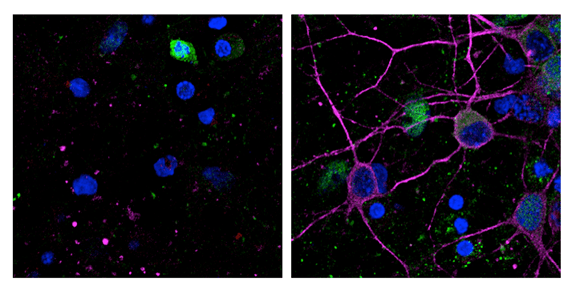 Comparativas de neuronas: La imagen de la izquierda muestra neuronas muertas por estímulos neurotóxicos y la de la derecha muestra neuronas que sobreviven al estímulo neurotóxico en presencia de la proteína PKD.