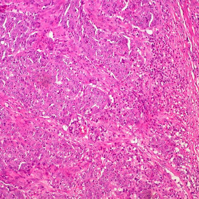 Muestra de un carcinoma medular de colon / Ed Uthman.