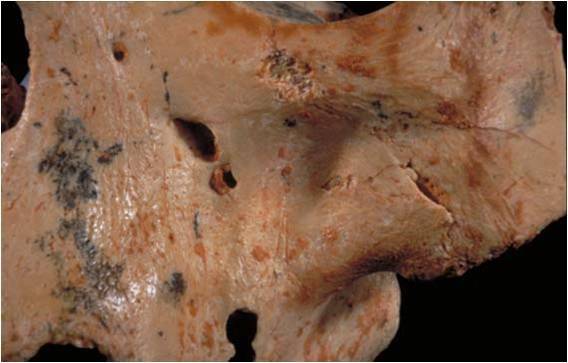 Restos de Homo antecessor canibalizados