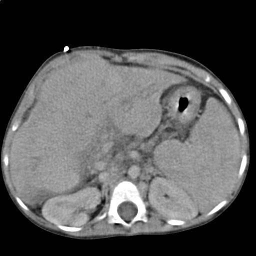 Hígado con cirrosis. Imagen: Wikipedia.