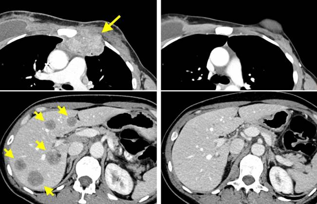 imagen del tórax y el hígado antes y durante el tratamiento