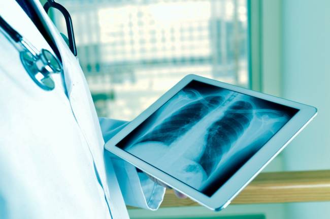 Médico mirando una radiografía de pulmón