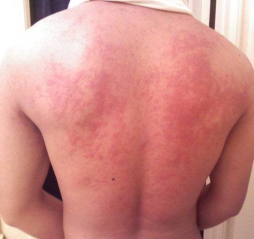 Eczema en la espalda