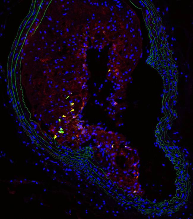 Células nestina+ en la placa de ateroma (en amarillo y rojo). En una sección del tronco braquiocefálico de ratón adulto. La capa de células musculares (en verde) delimita la luz del vaso