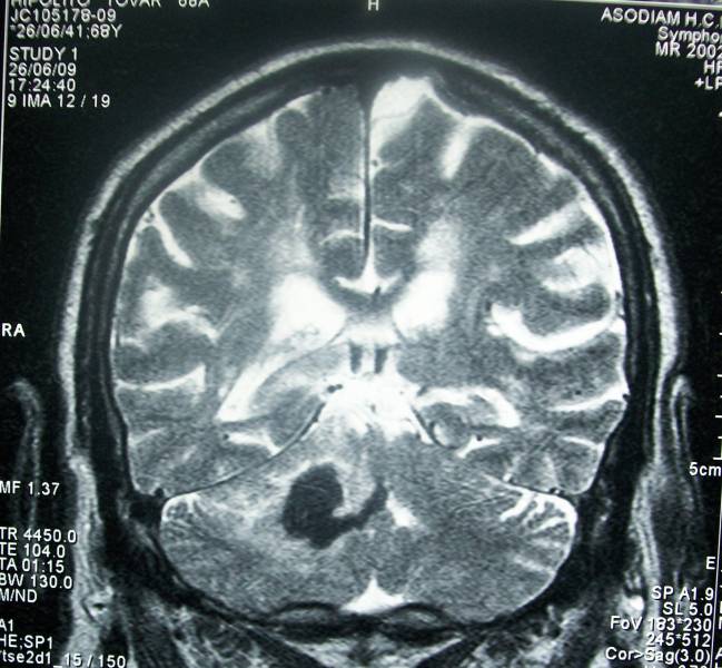 RMN de cráneo que muestra una hemorragia intracerebral profunda (zona oscura). / Wikipedia