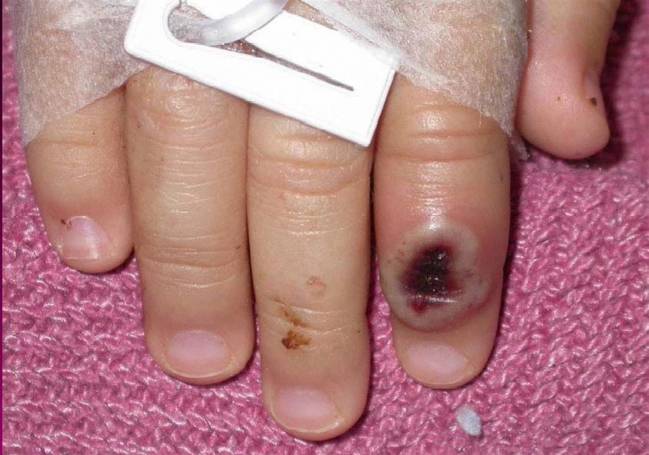 dedo de un niño infectado por la llamada viruela de mono 
