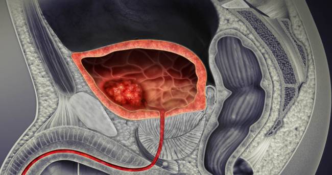 Ilustración 3D de un cáncer de vejiga