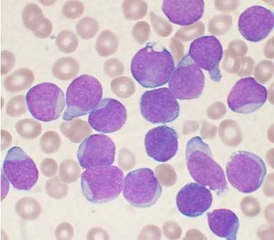 leucemia linfoblástica aguda