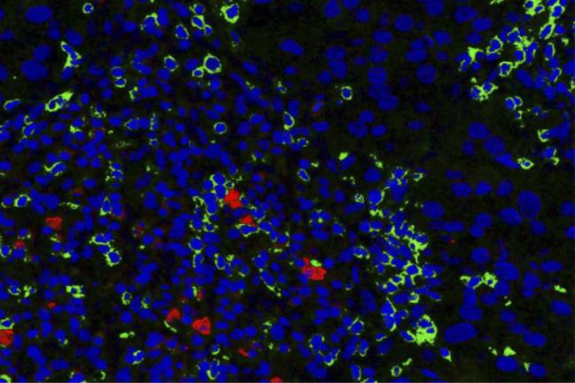 Linfocitos NK en tumor de mama HER2-positivo.