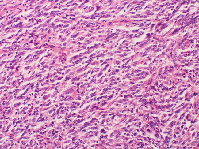 Muestra celular de melanoma con metástasis. / Yale Rosen