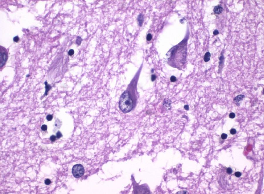 tejidos del hipocampo cerebral con alzhéimer