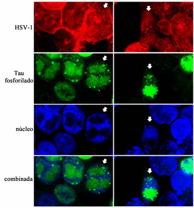 Células de neuroblastoma humano infectadas con HSV-1.