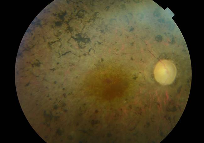 Fondo de ojo de un paciente con retinosis pigmentaria