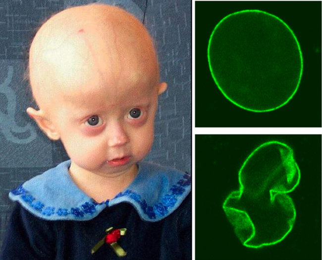 Niña afectada con progeria. / Wikipedia