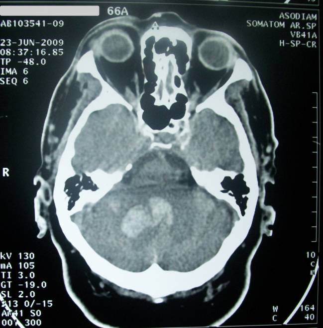 TAC que muestra un caso de accidente cerebrovascular hemorrágico