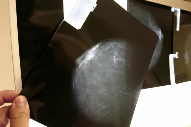 Radiografía mamaria