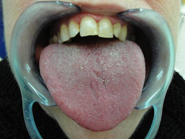 Aspecto de la lengua de una paciente con xerostomía por antidepresivos. 