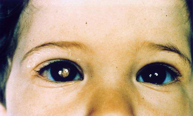Niño con retinoblastoma