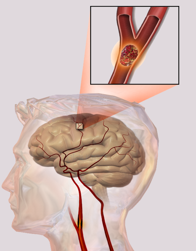 Infografía de un ictus cerebral. / Wikipedia