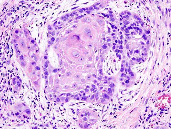Imagen histopatológica ilustrando células escamosas bien diferenciadas en un carcinoma. / Wikipedia