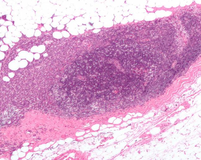 Ganglio linfático invadido por carcinoma de mama ductal