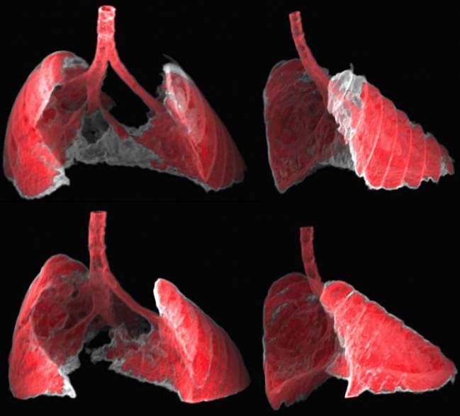 pulmones de un ratón con fibrosis
