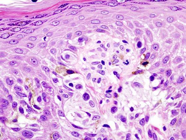 Histopathologic image of malignant melanoma (Case 01). Skin biopsy.