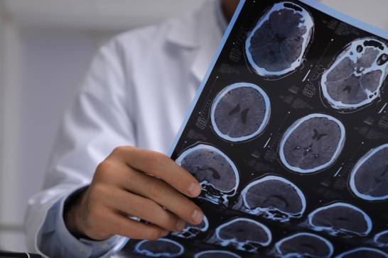 The State Research Agency allocates 31 million euros to projects against Alzheimer’s