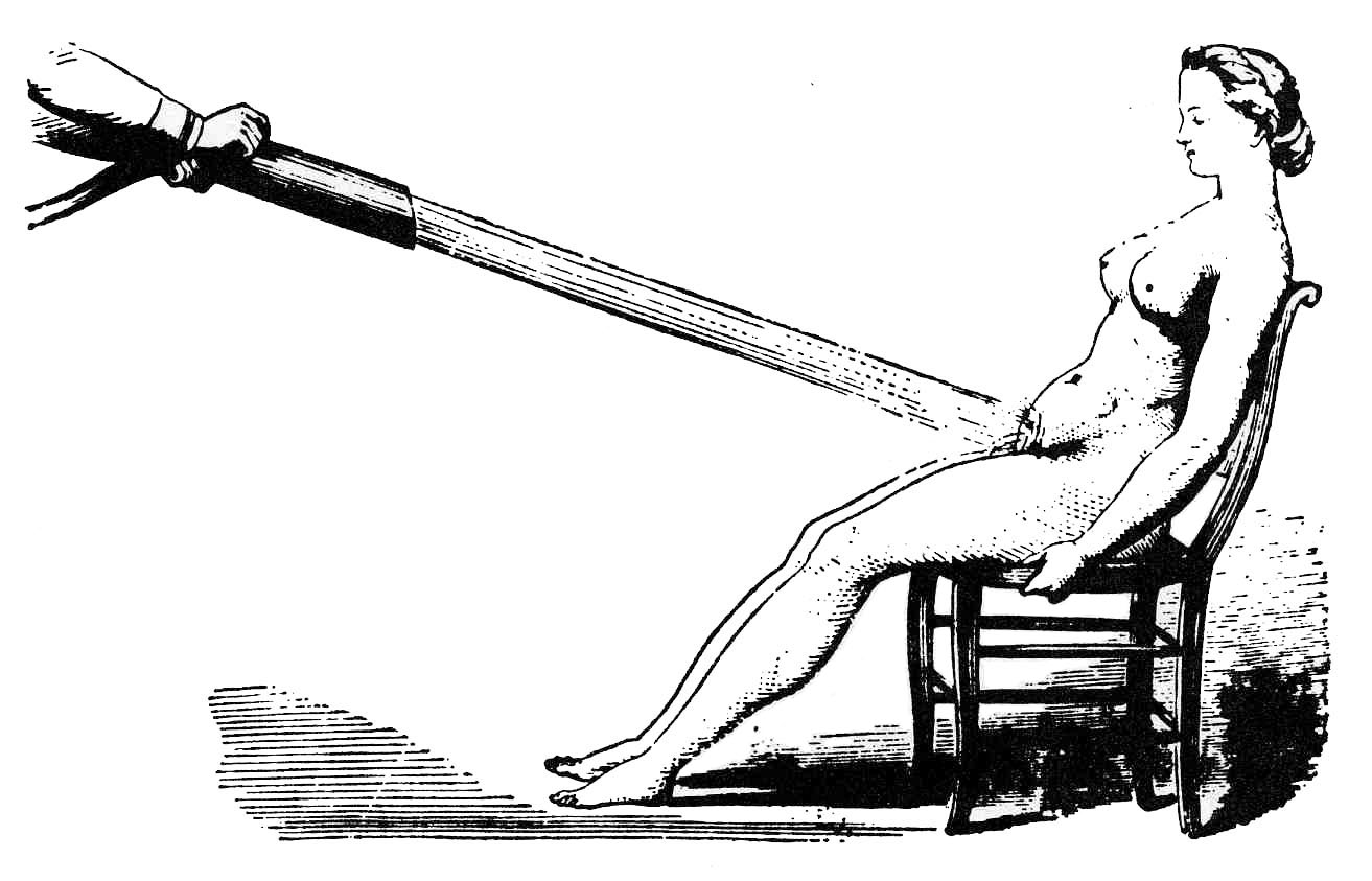 Duchas vaginales como tratamiento para la histeria. Wikimedia Commons